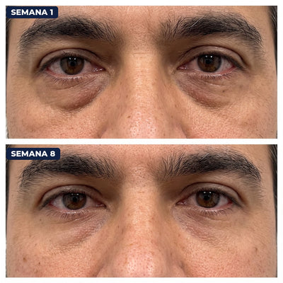 Antes y después con Firme Dura, ojeras semana 1 y semana 8