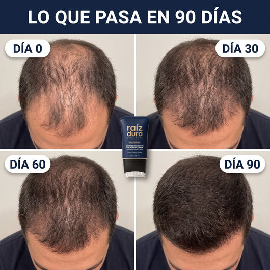 Coronilla en el día 0, 30, 60 y 90