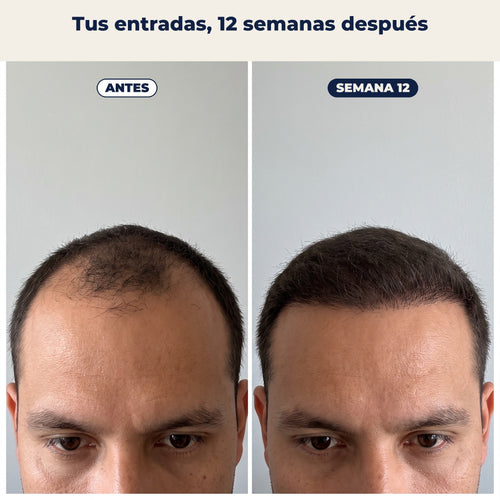 Raíz Dura: recupera tu pelo en entradas y coronilla